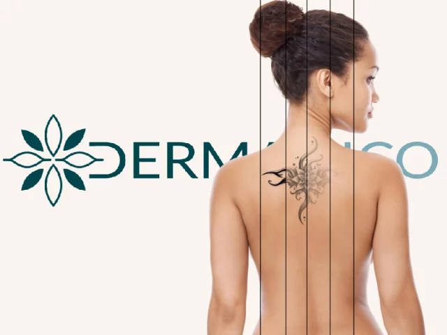 Centre de Détatouage Laser à Gland